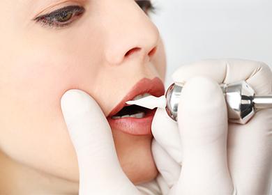 Augmentation des lèvres