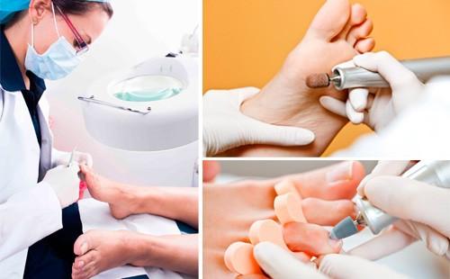 Les étapes du pédicure médical