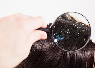 Caspa en el cabello.