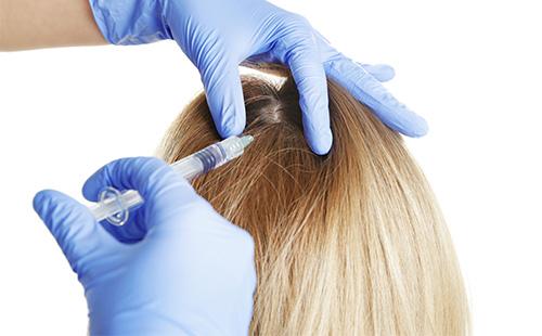 Injection dans le cuir chevelu