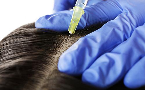 Inyección del cuero cabelludo