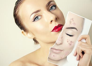 Cara con y sin acné