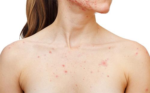 Pin sur la poitrine de la fille