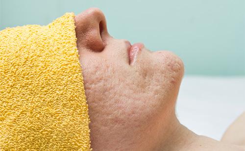 Fille avec des problèmes de peau