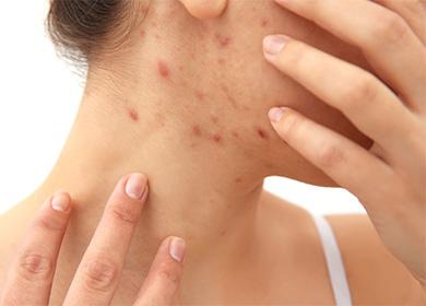 Acne no pescoço