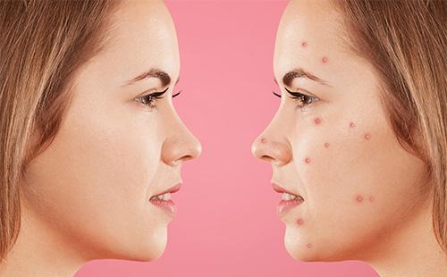 Pele com e sem acne