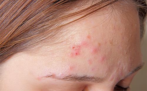 L'acné sur le front d'une fille