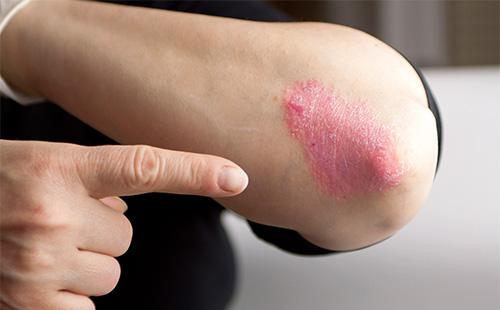 Psoriasis en el codo.