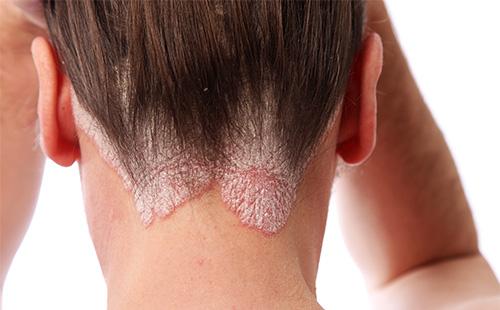 Psoriasis sur la tête